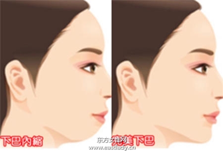 暴牙可以矯正嗎 矯正后可以瘦臉嗎