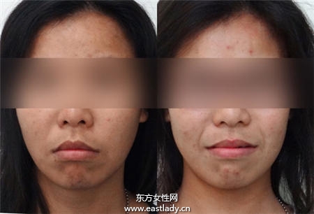 暴牙可以矯正嗎 矯正后可以瘦臉嗎