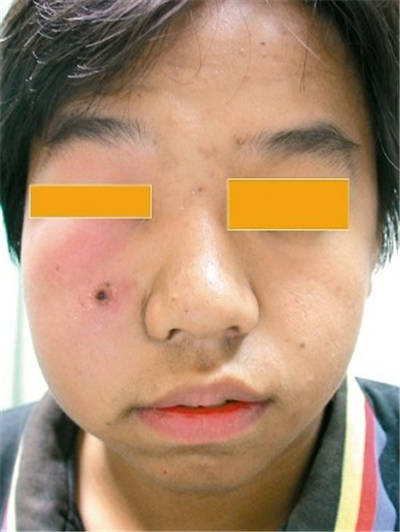 別把粉瘤當(dāng)粉刺 兩者到底有什么不同