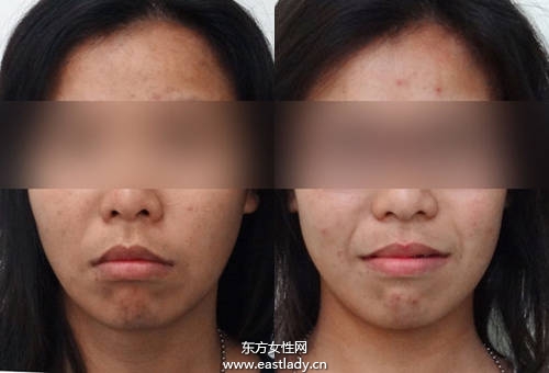 Angelababy 小S也做牙齒矯正 成功瘦小臉