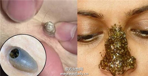 黑頭粉刺千萬不能擠 這樣去黑頭 讓你擺脫 草莓鼻