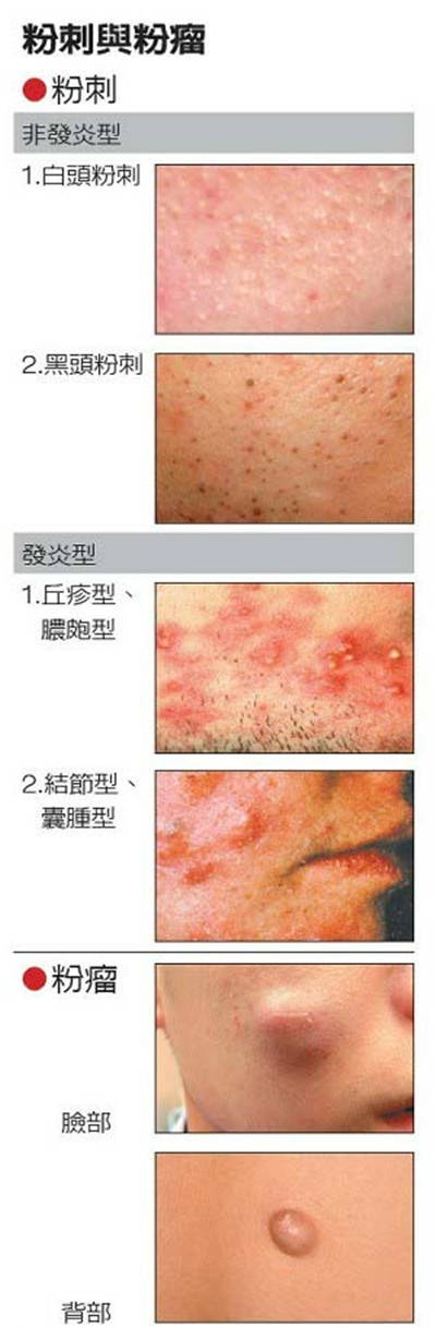 別把粉瘤當(dāng)粉刺 兩者到底有什么不同