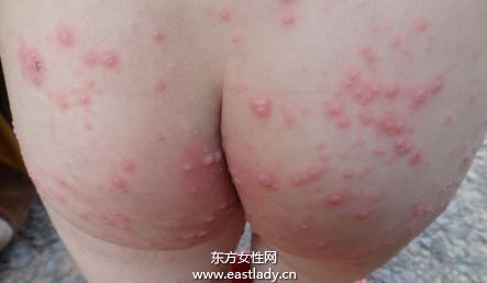 注意預(yù)防皮膚過敏