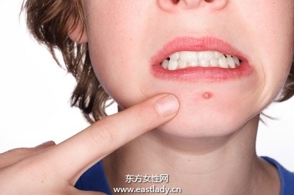 造成青春痘的原因以及治療方法