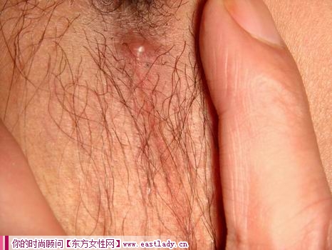 面部長癤子不能擠壓