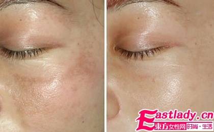 臉上長黑斑的原因以及治療方法