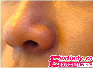 皮膚缺水表現(xiàn) 如何保濕