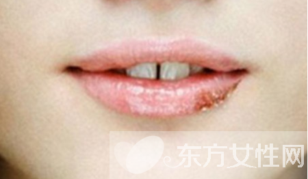嘴上起泡是什么原因 該怎么治療