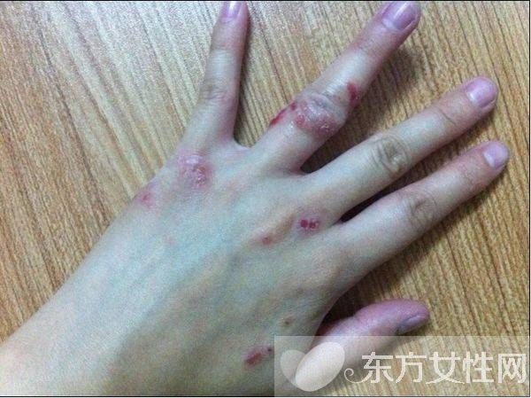 濕疹會傳染嗎 一些你不知道的治療濕疹小偏方推薦