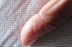 濕疹會傳染嗎 一些你不知道的治療濕疹小偏方推薦