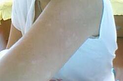 白色糠疹是什么 白色糠疹的病發(fā)原因是什么