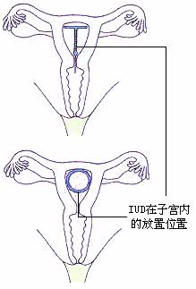 各種節(jié)育環(huán)的種類圖片介紹
