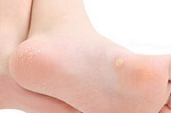 尖銳濕疣會癢嗎 揭尖銳濕疣早期癥狀