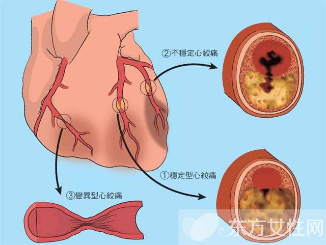 心絞痛的早期癥狀表現(xiàn) 出現(xiàn)這些狀況一定要引起重視