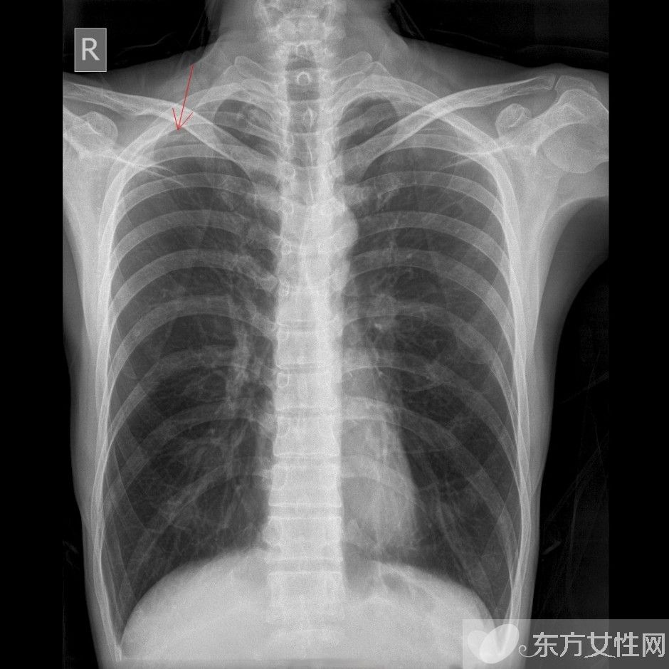 肺氣腫會(huì)傳染嗎 治療肺氣腫的食療偏方推薦