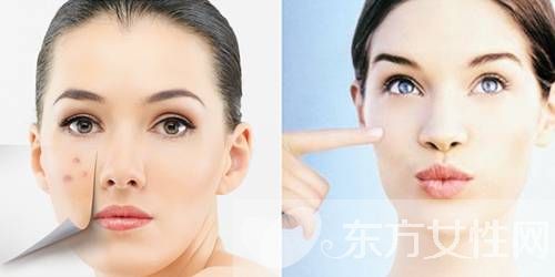 青春痘的治療小偏方 7個偏方幫你解決面子問題