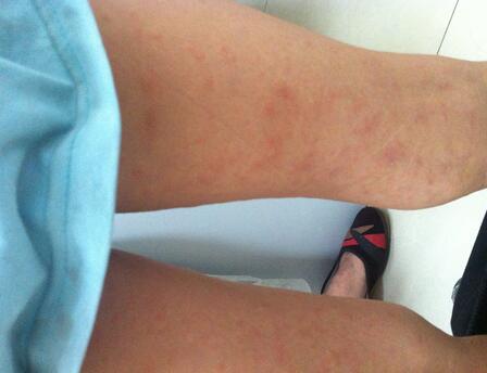 白色糠疹是什么 白色糠疹的病發(fā)原因是什么