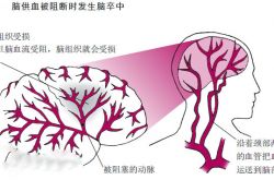 什么是腦卒中 這些細(xì)微的表現(xiàn)居然是它的早期癥狀