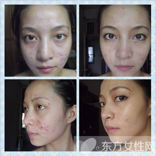 十大小偏方去粉刺痘痘 助你有效消除