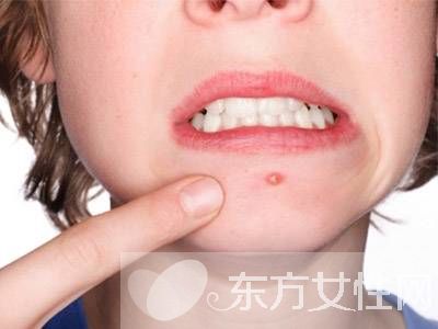 青春痘的治療小偏方 7個偏方幫你解決面子問題