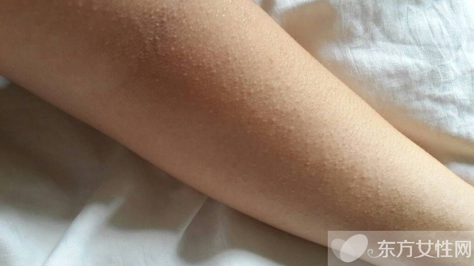 濕疹會傳染嗎 一些你不知道的治療濕疹小偏方推薦