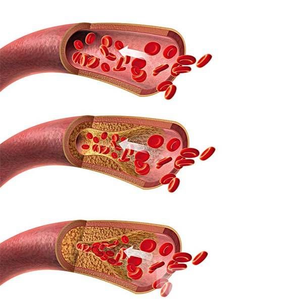 動脈硬化的癥狀表現(xiàn)有哪些 防止動脈硬化應(yīng)多吃這些