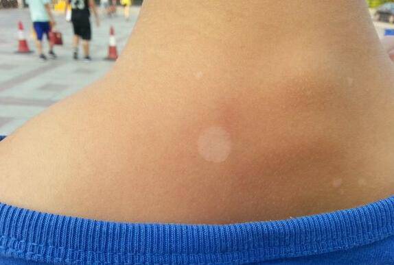 汗斑如何預防 薦5個有效治療小妙招