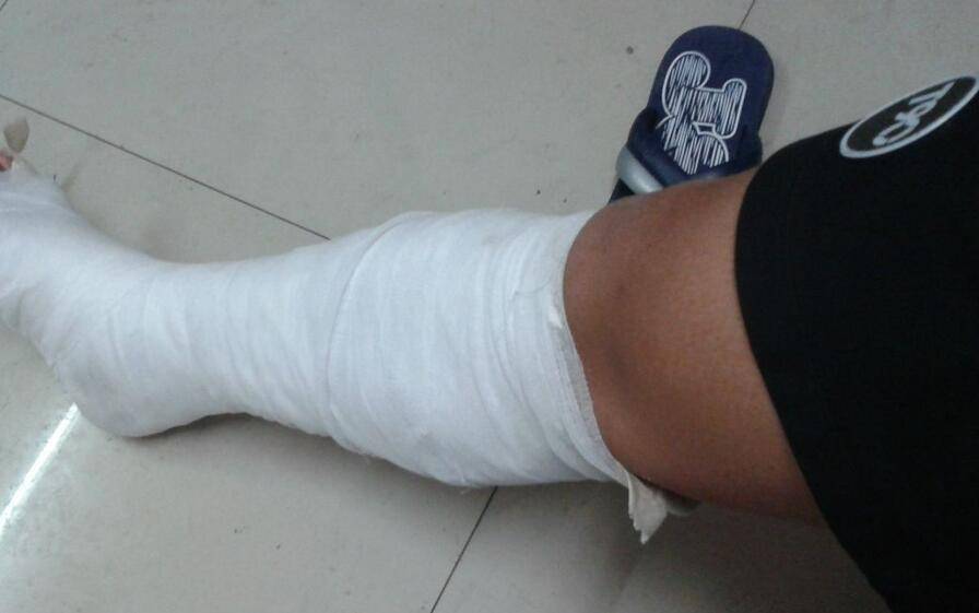 骨折愈合時(shí)間需要多久 愈合康復(fù)訓(xùn)練