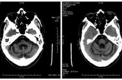 小腦萎縮的誘因及癥狀 小腦萎縮吃什么好