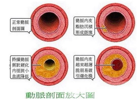 高血脂的治療與飲食 最見效的食療方法推薦