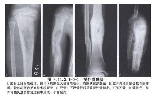 骨髓炎能治好嗎 揭秘骨髓炎癥狀危害