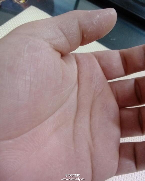 手上脫皮是怎么回事呢 輕松幾招讓你告別脫皮