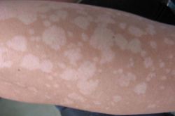 汗斑如何預(yù)防 薦5個有效治療小妙招