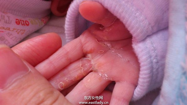 手上脫皮是怎么回事呢 輕松幾招讓你告別脫皮