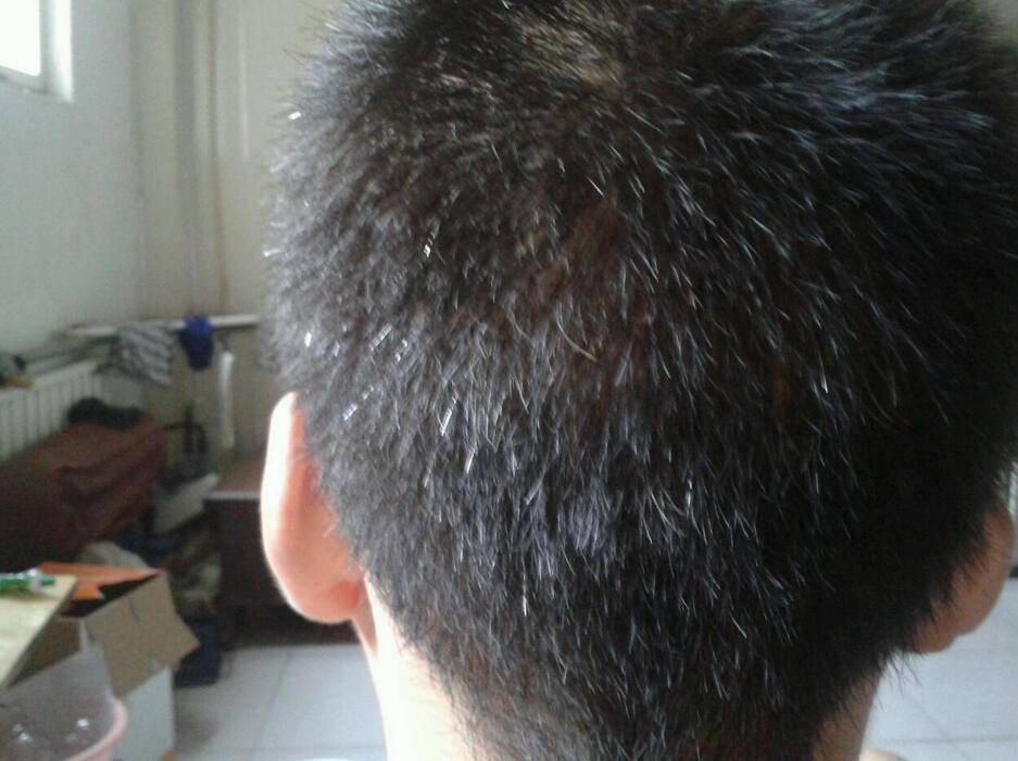 頭發(fā)變白形成原因 看哪些你已中招