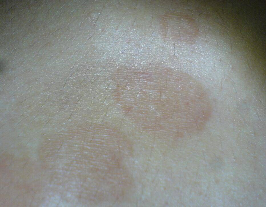 汗斑如何預防 薦5個有效治療小妙招