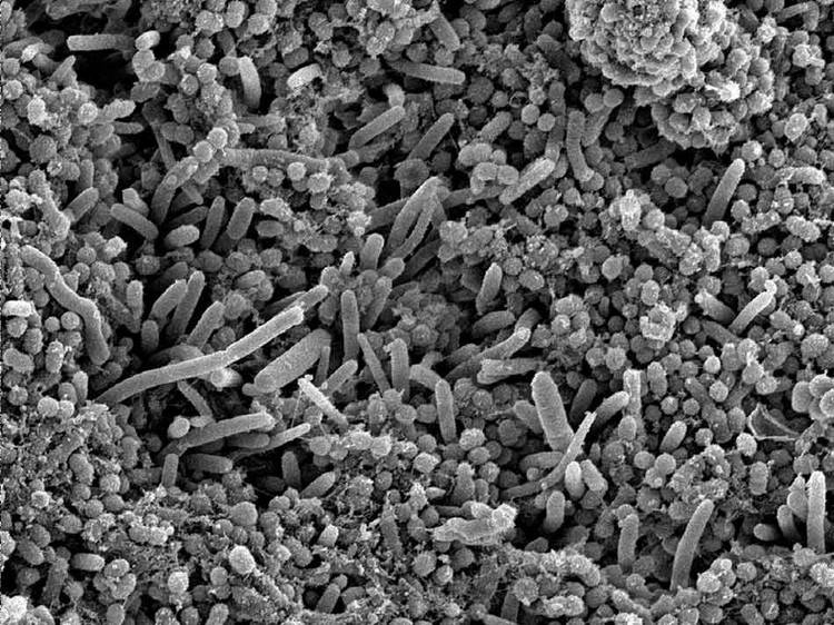 鏈球菌感染的不同表現(xiàn) 什么會導(dǎo)致鏈球菌感染