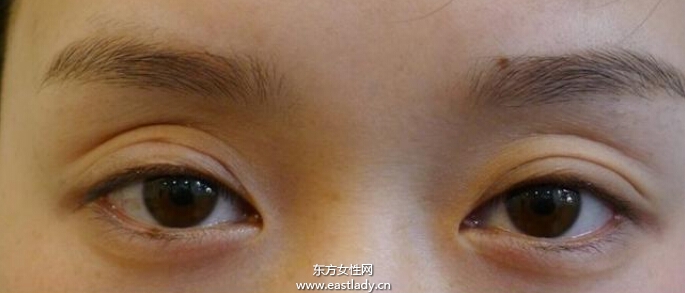 上眼皮突然下垂怎么辦 這可能是疾病信號