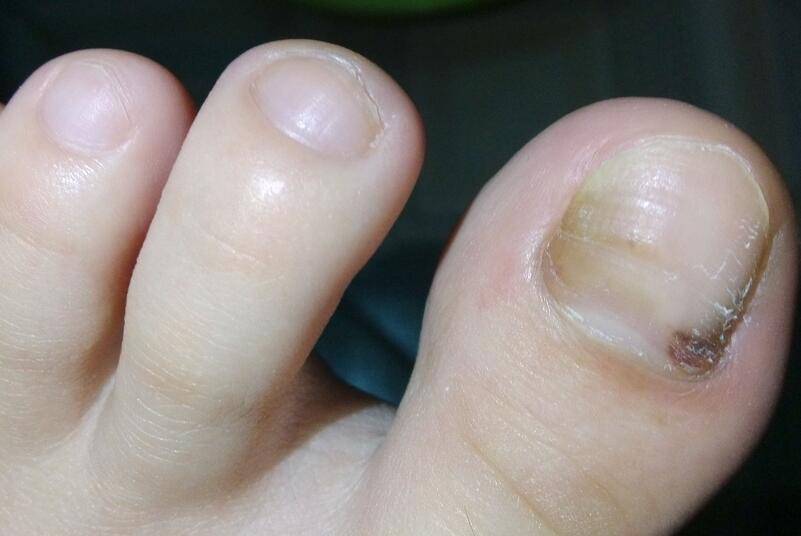 6個治療灰指甲的小偏方 灰指甲怎么預(yù)防