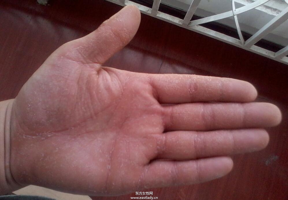手上脫皮是怎么回事呢 輕松幾招讓你告別脫皮