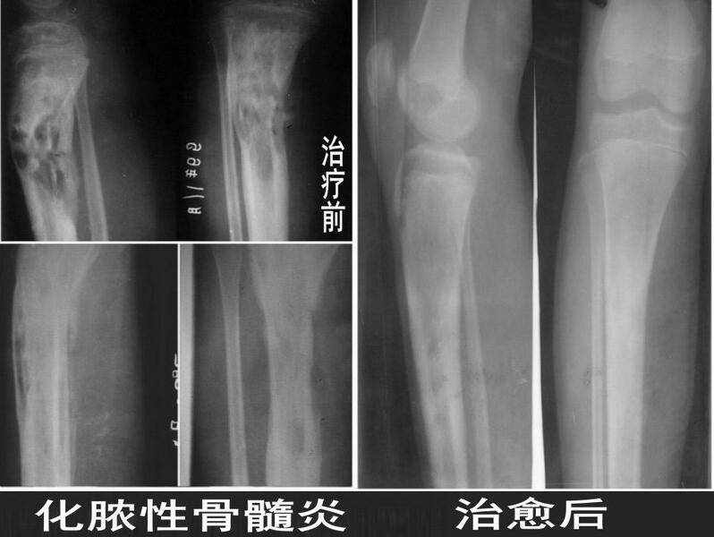 骨髓炎能治好嗎 揭秘骨髓炎癥狀危害