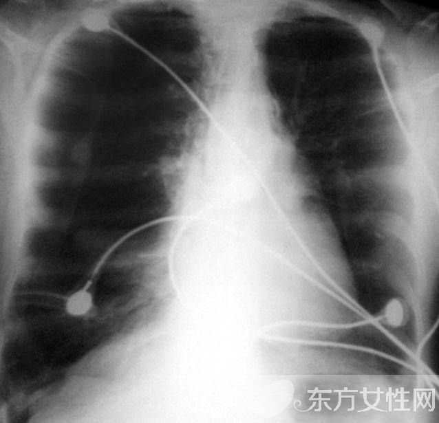 民間老年肺氣腫偏方推薦輔助治療小藥方大成效