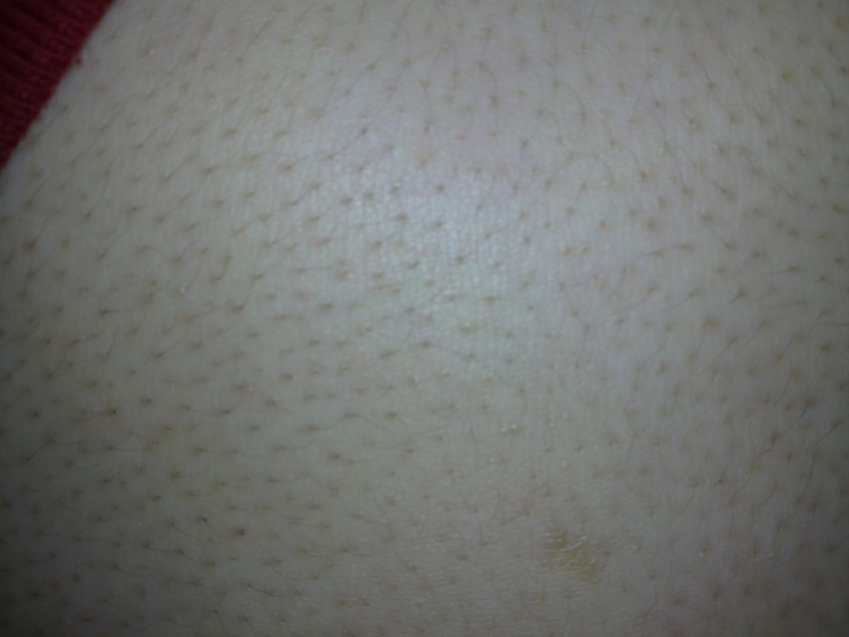 毛周角化是什么 揭你所不知的 雞皮膚 治療