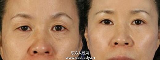 上眼皮突然下垂怎么辦 這可能是疾病信號