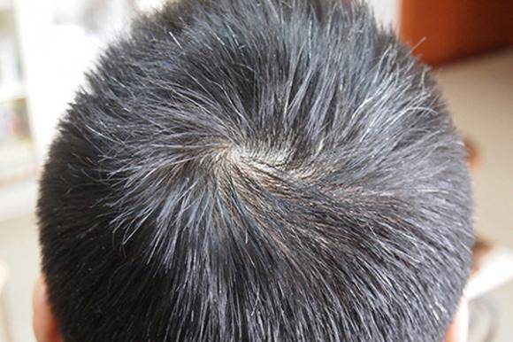 頭發(fā)變白形成原因 看哪些你已中招