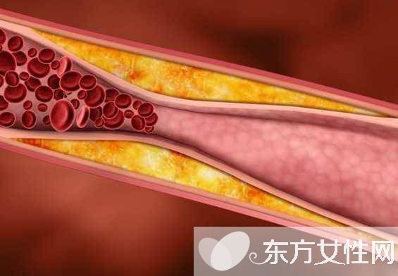 動脈硬化的癥狀表現(xiàn)有哪些 防止動脈硬化應(yīng)多吃這些