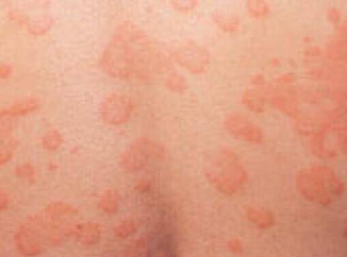 汗斑如何預防 薦5個有效治療小妙招