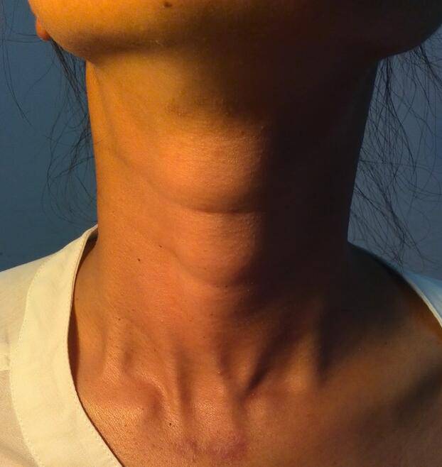 甲狀腺癌術(shù)后飲食禁忌 解讀甲狀腺癌各類癥狀