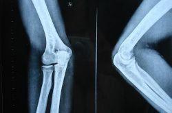 骨折愈合時間需要多久 愈合康復(fù)訓(xùn)練