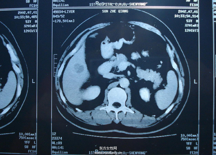 中晚期肝癌介入治療的方法有哪些